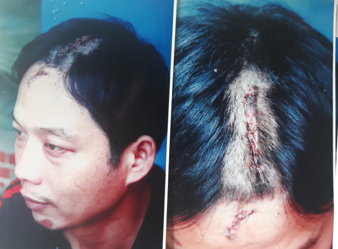 Vết thương anh Vinh bị ch&eacute;m được điều trị tại bệnh viện với tỉ lệ thương tật 12%.