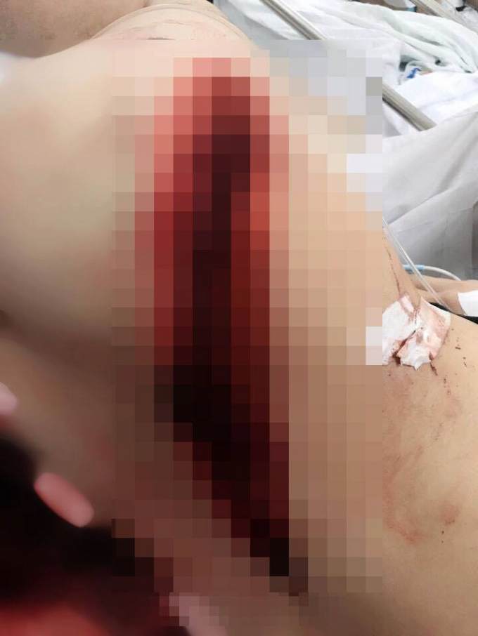 Nạn nh&acirc;n bị ch&eacute;m trọng thương trong t&igrave;nh trạng nguy kịch.