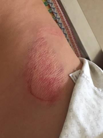 Theo chẩn đo&aacute;n của b&aacute;c sỹ, anh Quốc Việt bị g&atilde;y 1 xương sườn (ảnh ĐT)