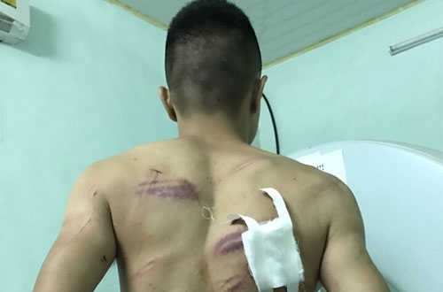 Anh Hưng với c&aacute;c vết thương sau trận&nbsp;truy s&aacute;t&nbsp;giữa ban ng&agrave;y.