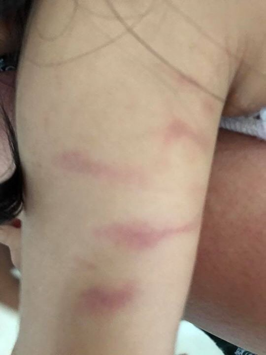 Bầm tr&ecirc;n người ch&aacute;u Th.&nbsp;