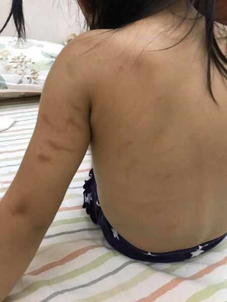 Theo mẹ ch&aacute;u Th. th&igrave; vết bầm tr&ecirc;n người ch&aacute;u vẫn c&ograve;n cho đến ng&agrave;y 9/6.