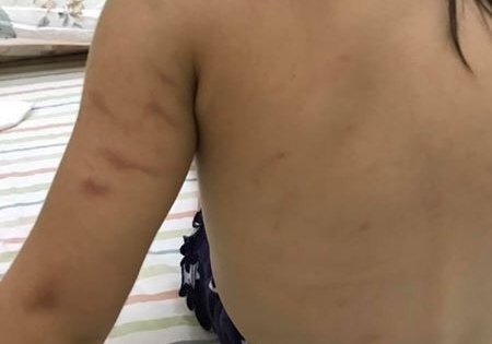 Huế: Bé gái bị bầm tím ở trường, nhà trường giải thích do “cô và cháu giằng co”