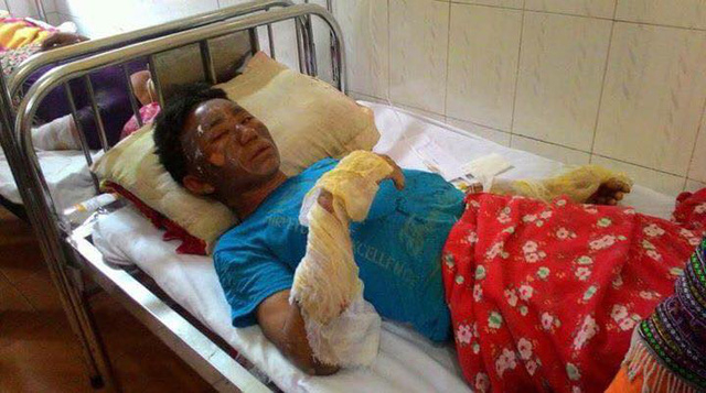 Nạn nh&acirc;n bị bỏng kh&iacute; gas đang điều trị tại Bệnh viện đa khoa huyện Bắc H&agrave;.