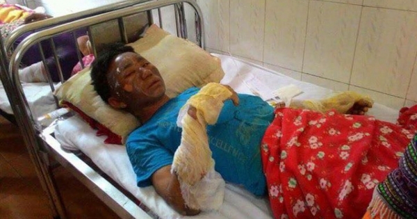 Lào Cai: Nổ khí gas, 10 người đang ăn cơm bị bỏng nặng