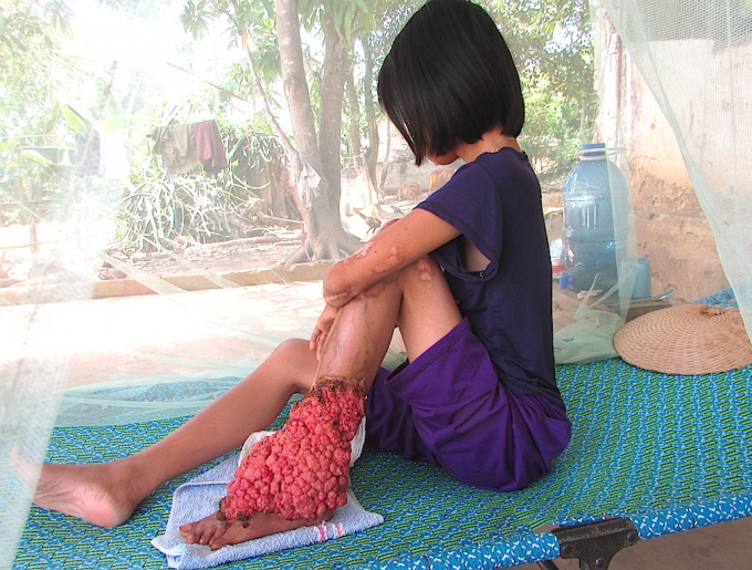 H&agrave;ng ng&agrave;y Thanh phải chịu trăm ng&agrave;n nỗi đau v&igrave; căn bệnh qu&aacute;i &aacute;c h&agrave;nh hạ.