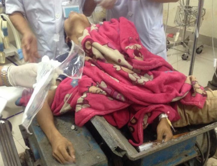 Ch&acirc;n phải bị m&aacute;y l&agrave;m gạch nghiền n&aacute;t. Ảnh: BV cung cấp