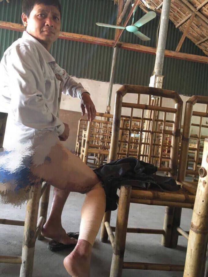 Vết thương của &ocirc;ng Chỉnh do bị tưới xăng đốt.