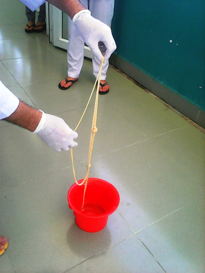 S&aacute;n xơ m&iacute;t d&agrave;i 10 m&eacute;t được lấy ra từ bệnh nh&acirc;n M.