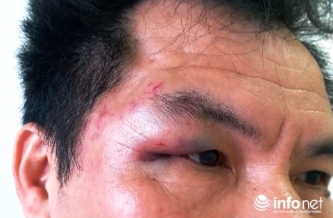 Trưởng đại diện Tạp chí Hoà nhập bị đánh túi bụi tại Nghệ An