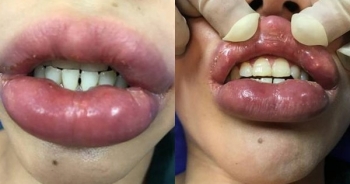 Tiêm filler làm đẹp, cô gái tều môi vì gặp biến chứng