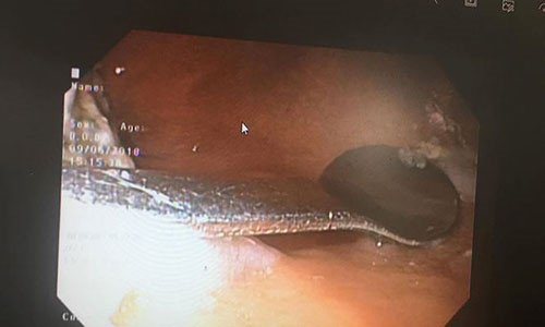 H&igrave;nh ảnh chiếc th&igrave;a bằng kim loại được lấy dần ra khỏi cơ thể bệnh nh&acirc;n.