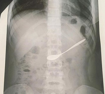 H&igrave;nh ảnh chụp Xquang cho thấy chiếc th&igrave;a nằm trong dạ d&agrave;y của nữ bệnh nh&acirc;n.