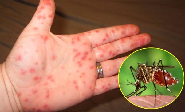 C&aacute;ch ph&acirc;n biệt sốt xuất huyết với sốt virus th&ocirc;ng thường