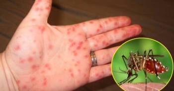 Cách phân biệt sốt xuất huyết với sốt virus thông thường