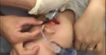 Cứu sống thần kỳ bé trai 2 tuổi ngưng tim, ngưng thở do hóc thạch rau câu