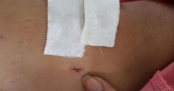 Bệnh viện Chợ Rẫy khoan nhầm chân bệnh nhân, đình chỉ 2 nhân viên y tế