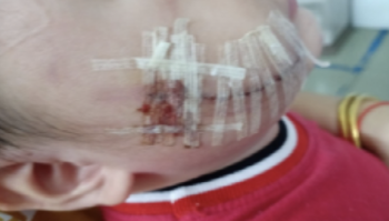 Xót xa trước hình ảnh cháu bé 2 tuổi bị chó cắn tổn thương mặt