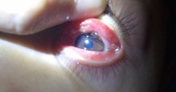 Phát hiện vắt dài 2cm hút no máu trong mắt cháu bé 8 tuổi