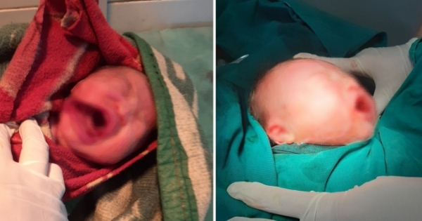 Tự đẻ tại nhà, bé sơ sinh bị dao cắt rách mặt