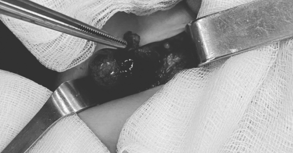 Hà Nội: Cắt tinh hoàn bị xoắn hoại tử cho bệnh nhi 10 tháng tuổi