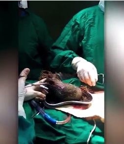 Mắc hội chứng nghiện ăn t&oacute;c: B&agrave; mẹ nuốt hơn 6kg t&oacute;c v&agrave;o bụng l&uacute;c ngủ