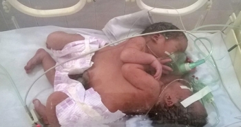 Hà Giang: Bác sỹ ra chợ kêu gọi quyên góp tiền cứu cặp song sinh dính liền