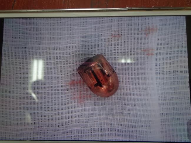 Vi&ecirc;n đạn lấy ra từ cổ bệnh nh&acirc;n