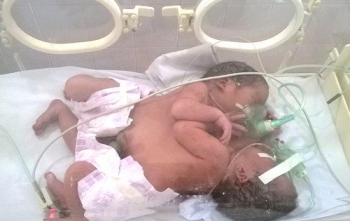 Hai trẻ song sinh dính liền ở Hà Giang: “Khả năng phẫu thuật tách rời rất khó”