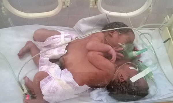 Cặp song sinh d&iacute;nh liền ở H&agrave; Giang đ&atilde; tử vong tr&ecirc;n đường về nh&agrave;.