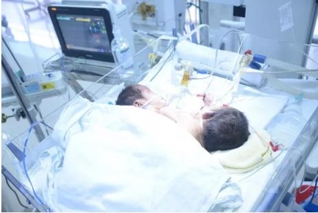 Cặp song sinh d&iacute;nh li&ecirc;̀n ở H&agrave; Giang đ&atilde; tử vong tr&ecirc;n đường v&ecirc;̀ nh&agrave;, người mẹ chưa 1 l&acirc;̀n được nh&igrave;n con l&uacute;c s&ocirc;́ng. Ảnh: Gia đ&igrave;nh v&agrave; X&atilde; h&ocirc;̣i