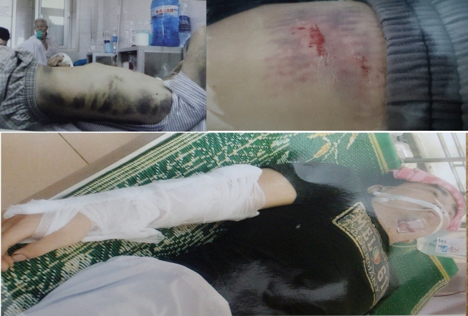 Nạn nh&acirc;n bị đ&aacute;nh g&atilde;y c&aacute;nh tay phải, dập l&aacute; l&aacute;ch độ 3, thiếu m&aacute;u trầm trọng, to&agrave;n th&acirc;n bầm t&iacute;m,...&nbsp;