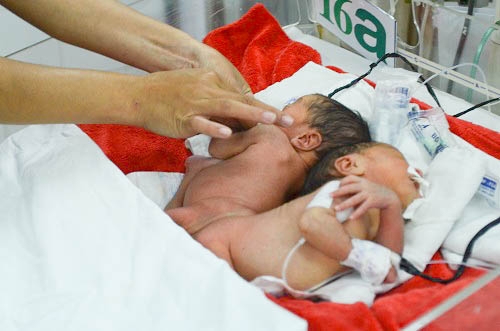 Hiện tại hai b&eacute; nằm lồng ấp, truyền dịch để nu&ocirc;i ăn tĩnh mạch to&agrave;n phần, ăn sữa tối thiểu để thăm d&ograve; ti&ecirc;u h&oacute;a sữa v&agrave; lưu th&ocirc;ng đường ti&ecirc;u ho&aacute;.