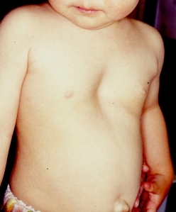 Bệnh nhi bị lõm ngực tăng bất thường tại TP HCM