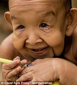 Cậu b&eacute; 4 tuổi mang ngoại h&igrave;nh &ocirc;ng l&atilde;o 80 v&igrave; mắc bệnh lạ