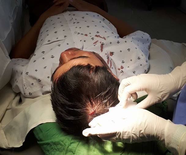 B&aacute;c sỹ Nguyễn Văn Long bị kh&acirc;u 5 mũi ở đầu.