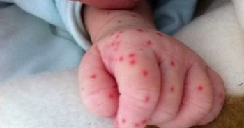 Phân biệt sốt xuất huyết và sốt phát ban