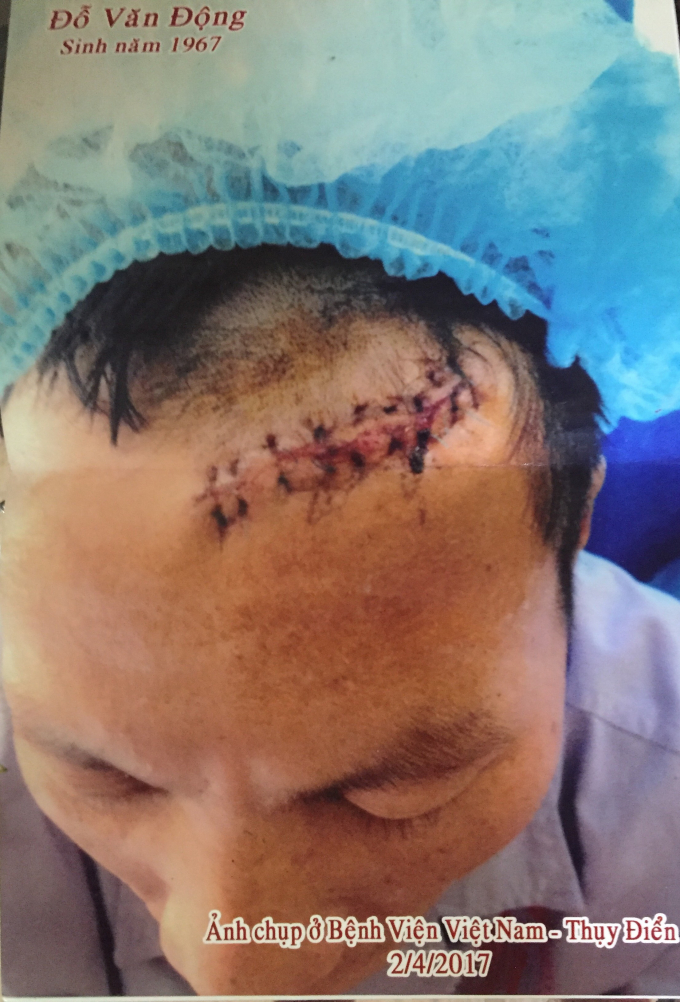 &Ocirc;ng Động với vết thương tr&ecirc;n đầu. (Ảnh gia đ&igrave;nh cung cấp).