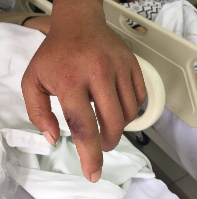 Bệnh nh&acirc;n bị rắn cắn đang điều trị tại BV Bạch Mai. Ảnh: Đ.H.