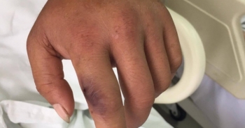 Bác sĩ cảnh báo mùa rắn độc