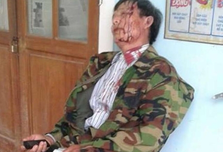 Thừa thiên Huế: Trưởng Công an bị cho thôi chức vì đánh dân nhập viện