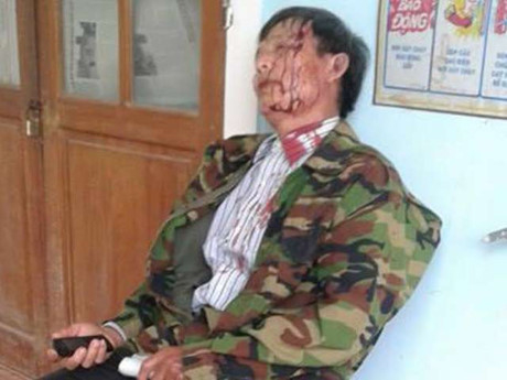 Thương t&iacute;ch tr&ecirc;n người &ocirc;ng Văn Đức Nguy&ecirc;n tại thời điểm bị &ocirc;ng Trần Văn T&iacute;n đ&aacute;nh. Ảnh V.H.