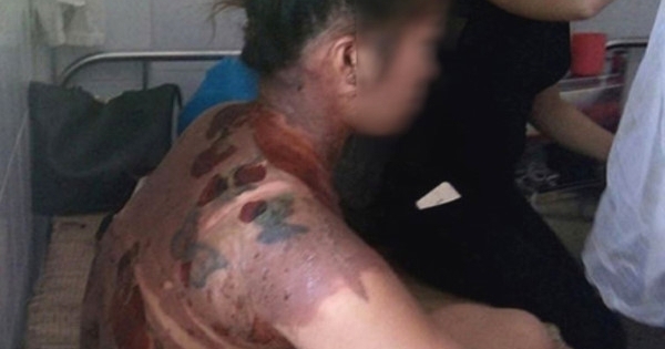 Thanh Hóa: Khởi tố kẻ hắt nước sôi vào người vợ đòi quà cưới