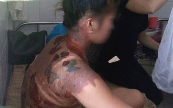 Chị Vui đang được điều trị tại bệnh viện.