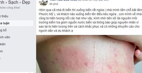 Xuất hiện t&igrave;nh trạng mẩn ngứa, di ứng khi đi tắm biển những ng&agrave;y vừa qua.