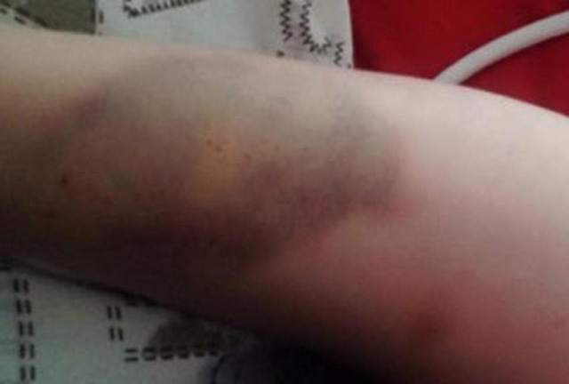 Những vết th&acirc;m t&iacute;m Binks g&acirc;y ra tr&ecirc;n cơ thể bạn g&aacute;i mang bầu.