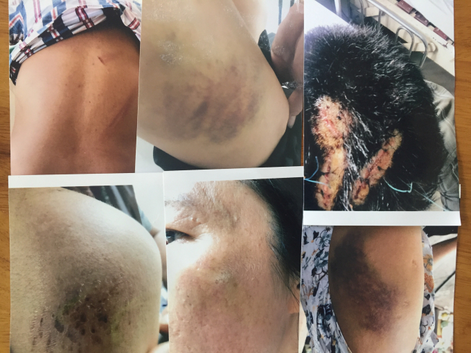 Nhiều người trong gia đ&igrave;nh b&agrave; Ba bị thương t&iacute;ch do c&aacute;c đối tượng g&acirc;y ra.