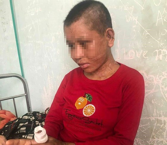 Chị Nhi&ecirc;u đang được điều trị tại Trung t&acirc;m Y tế huyện Đak Glei.