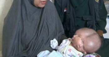 Em bé chào đời với hai gương mặt