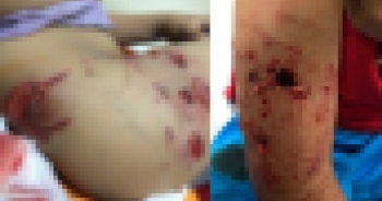 Thêm 2 bé trai bị chó dữ cắn rất thương tâm, phải nhập viện